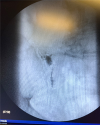 Sacroplasty for Sacral Fractures